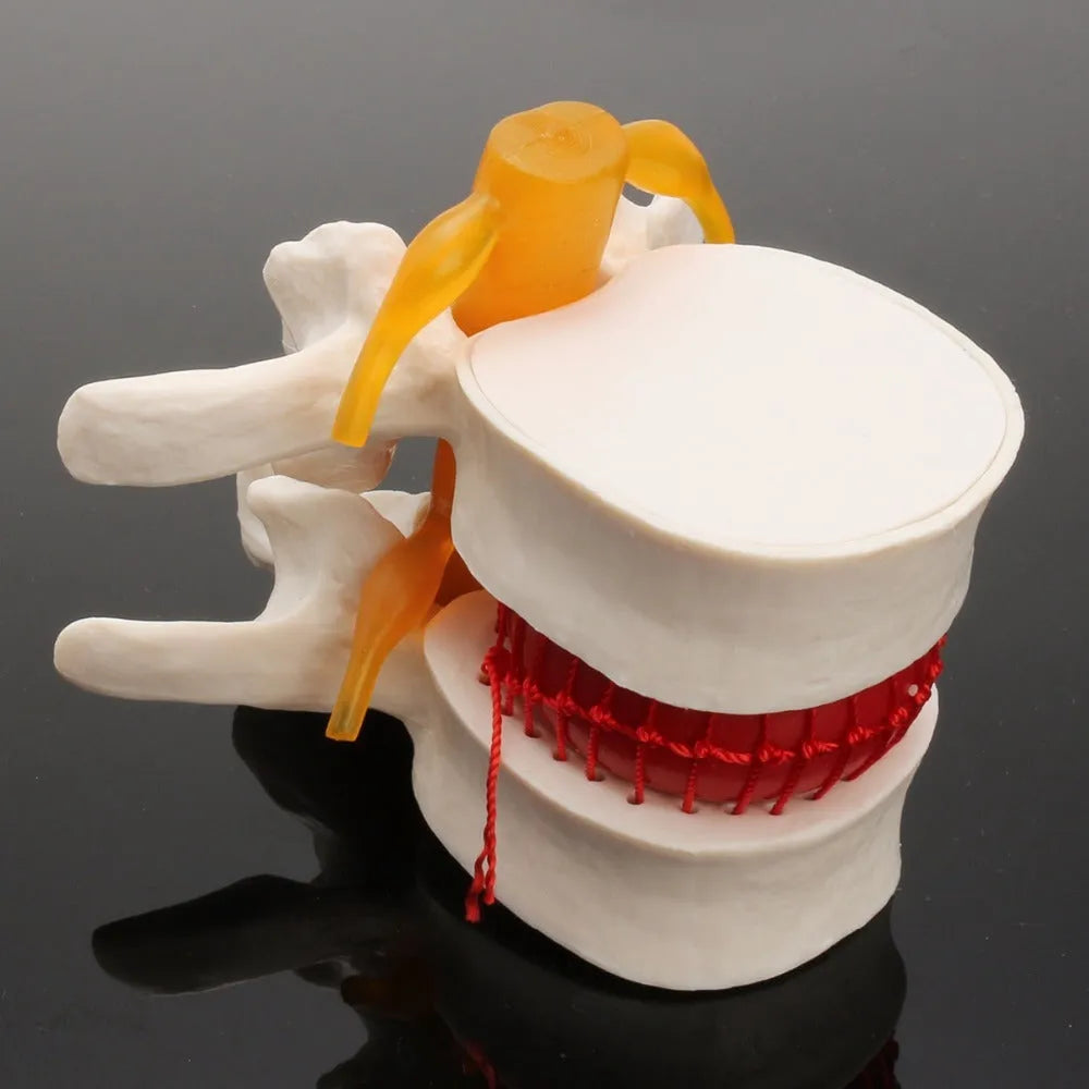 White PVC lumbar intervertebral disc herniation demonstration model for medical education